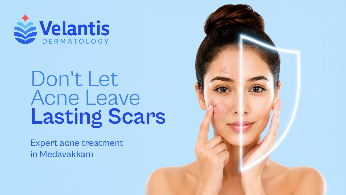Can Delaying Acne Treatment Lead to Permanent Scarring?