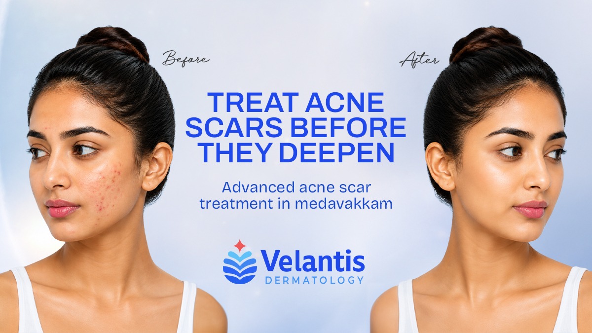 Are Acne Scars Becoming Harder to Treat? When Should You Start Treatment?