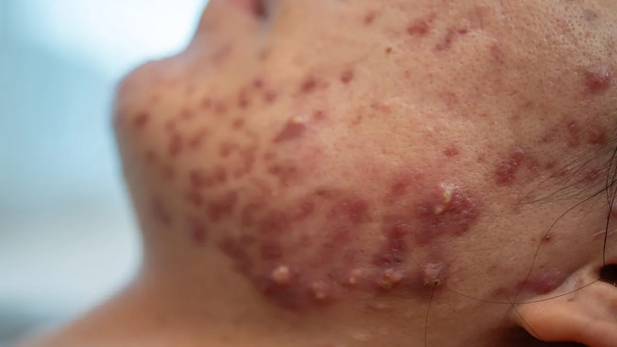 Acne Vulgaris: Types, Causes, and Treatments