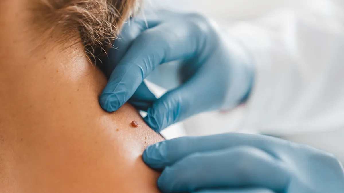 Mole Removal: Dermatologist Procedure and Aftercare