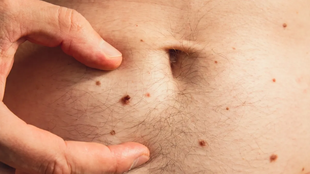 Dermatologist Tips for Removing Skin Tags