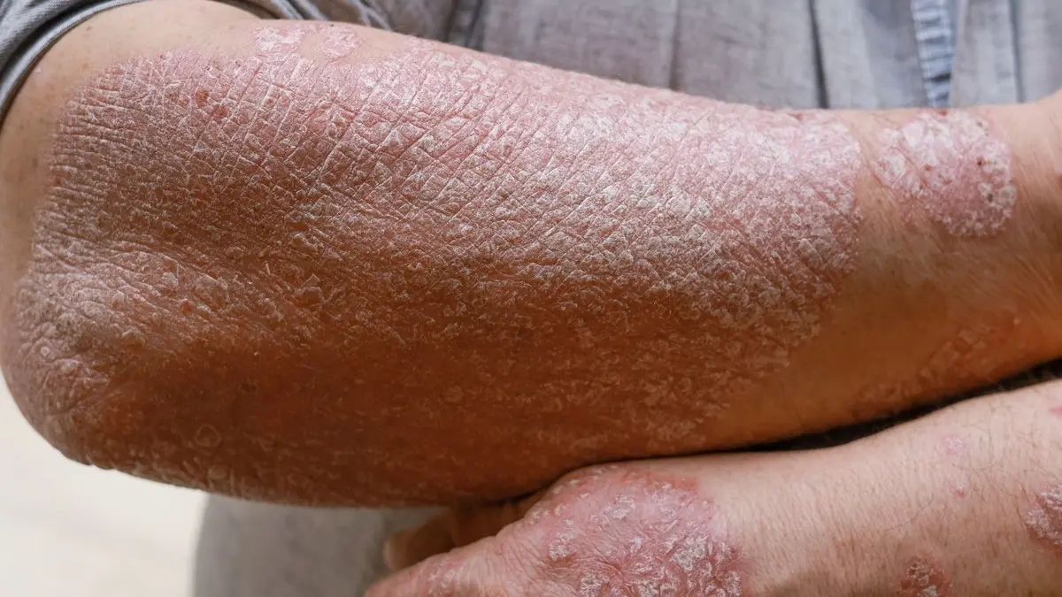 Laser Treatment for Psoriasis: Types, Working Cost, & Risks