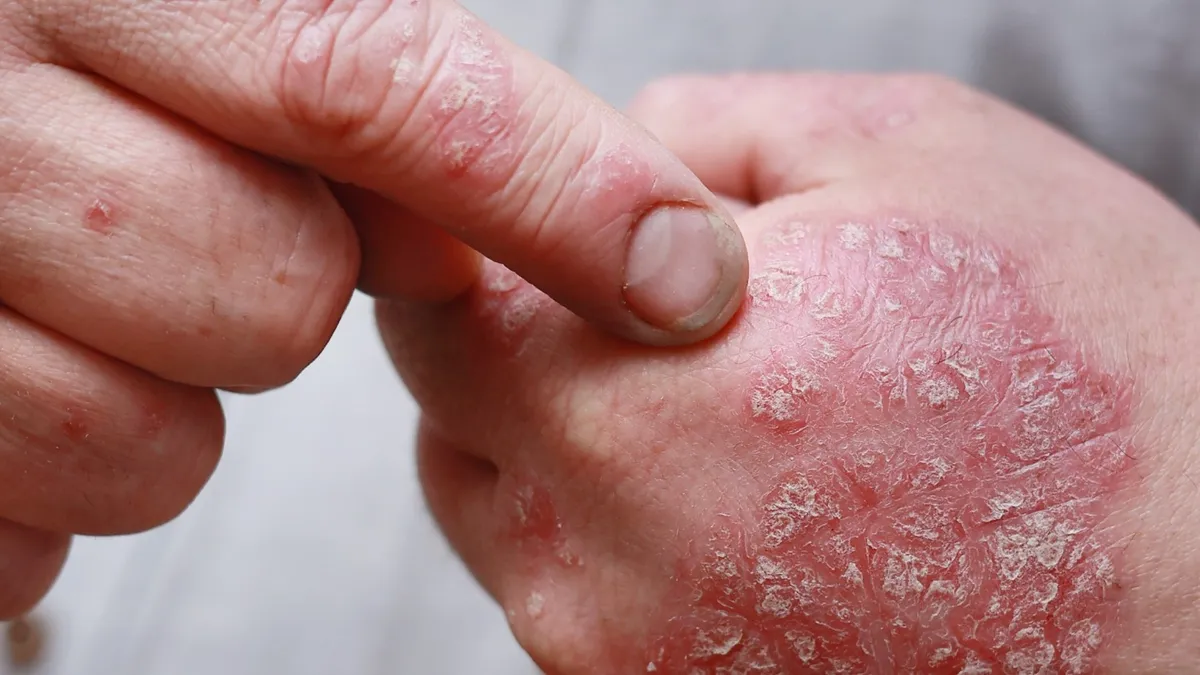 Best Psoriasis Treatment in Chennai