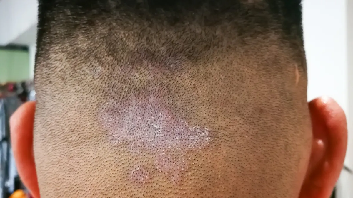 Scalp Fungal Infection: Symptoms, Causes, and Treatment